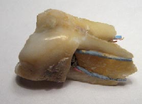 dente devitalizzato 